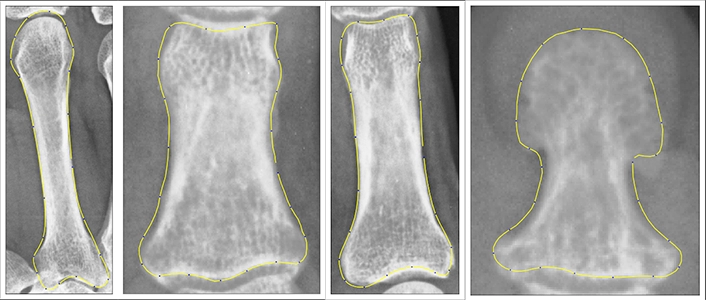 annotated X-ray